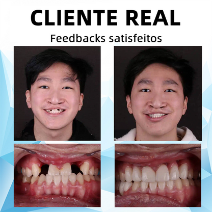 𝐁𝐢𝐤𝐞𝐧𝐝𝐚™ Conjunto de dentaduras com forro de silicone🔥 (⏰Desconto limitado, apenas 30 minutos restantes!⏰) 🦷👩‍⚕️